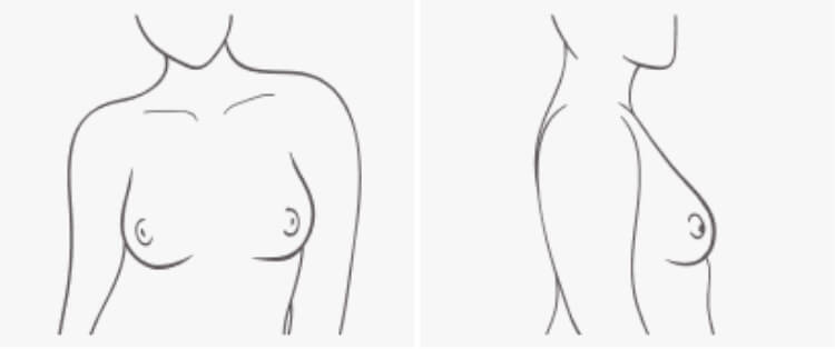Breast Shape Fit Impacts